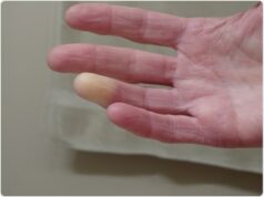 Maladie de Raynaud : Symptômes, Causes et Solutions pour Mieux Vivre maladie de Raynaud