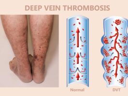 Thrombose veineuse profonde (TVP)