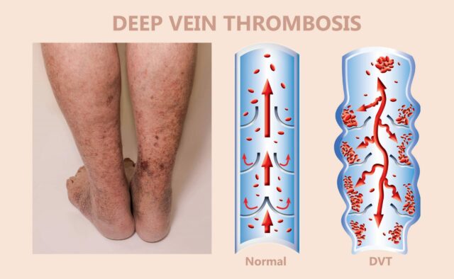 Thrombose veineuse profonde (TVP)