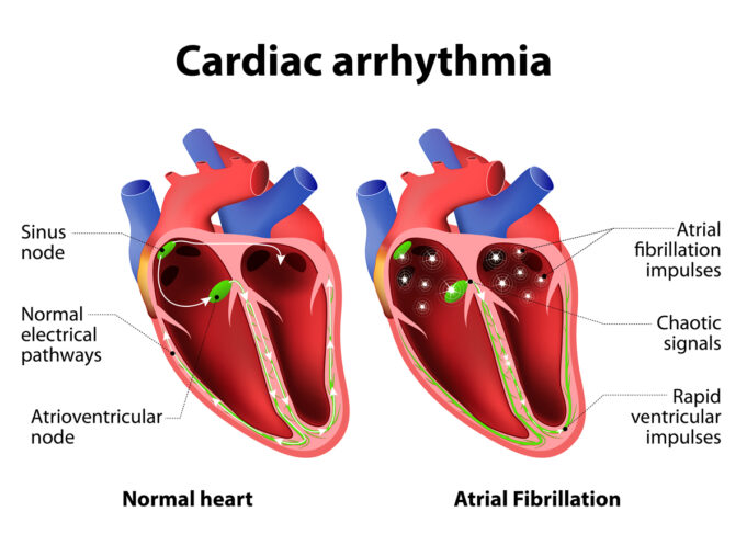 ARYTHMIE CARDIAQUE