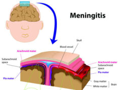 Ce qu’il faut savoir sur la méningite B