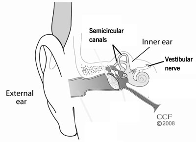 La maladie de Ménière (aussi appelée hydrops endolymphatique idiopathique) est un trouble chronique de l’oreille interne qui peut affecter à la fois l’équilibre et l’audition.