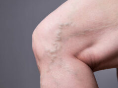 Quand s’inquiéter des varices