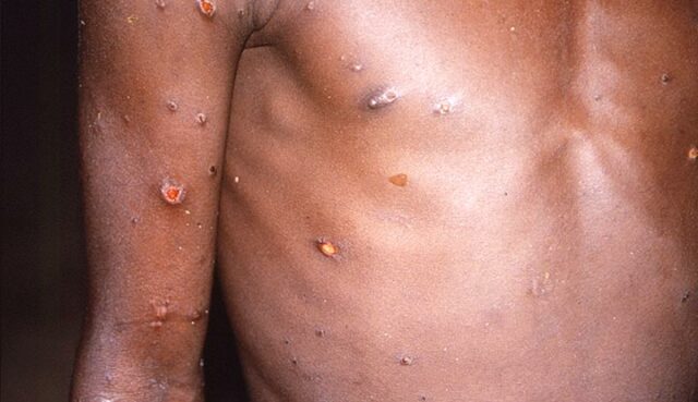 monkeypox