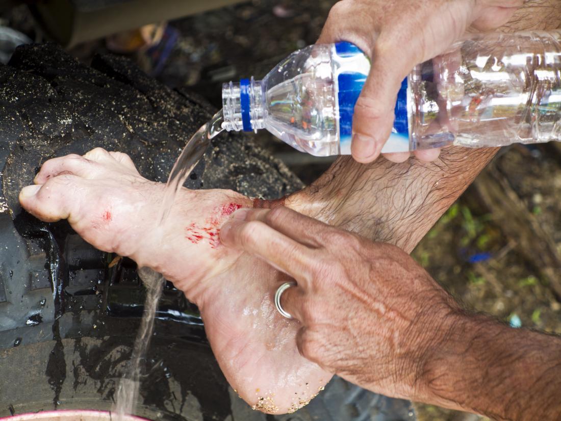 homme lavant une blessure au pied avec de l'eau