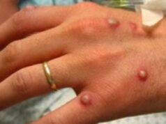 Monkeypox : l’une des maladies mondiales prédominantes cette année avec les immunodéficiences induites par le COVID-19
