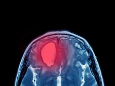 Anévrismes cérébraux non rompus | Médecine Johns Hopkins