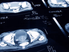 Qu’est-ce qu’un traitement individualisé du cancer de la prostate ?