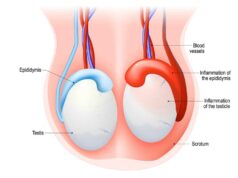 Orchite ( oreillons testicule )