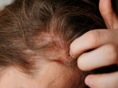 Psoriasis léger : symptômes et traitements efficaces Psoriasis léger