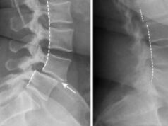 Top 5 des exercices pour la spondylose lombaire