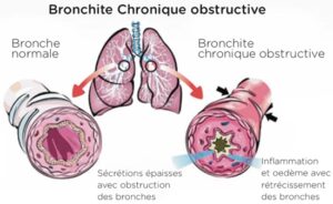 Bronchite chronique obstructive BPCO