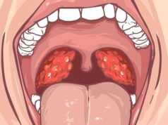 An illustration of the tonsils showing the location of the caseum.