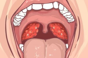 Une illustration des amygdales montrant la localisation du caseum.